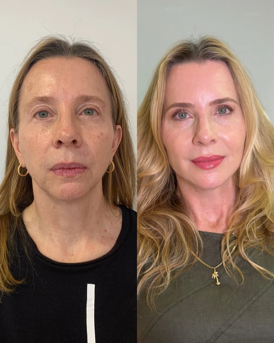 Caso 1: comparação frontal de antes e depois, conforme publicação da Dra. Patrícia Almeida