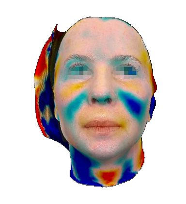 Registro tridimensional da superfície facial com mapa de diferenças e escala em milímetros.